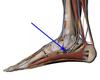 tibialis posterior tendon