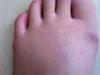 irritation of bunion and tailors bunion 