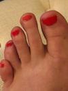 comparison of normal toe/foot (left foot)