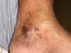 Pic of sores/spots on Ankle.