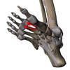 capsulitis of second and third toes