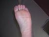 bruised foot