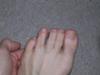 Morton's neuroma