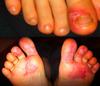eczema or athletes foot?