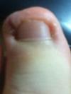 infected ingrown toe nail