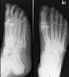 non displaced fifth metatarsal fracture