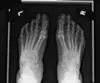 osteoporosis in the foot