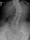 scoliosis