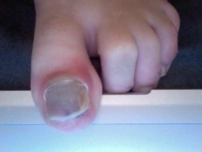 infected big toe