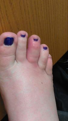 red and swollen toe