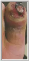 osteomyelitis