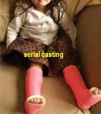 toe walking serial casting