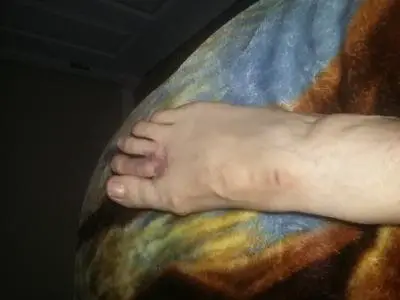 top of foot bruising