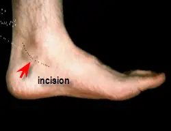 curvilinear incision for tarsal tunnel