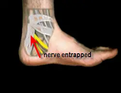 entrapped nerve under laciniate ligament