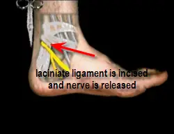 release of laciniate ligament