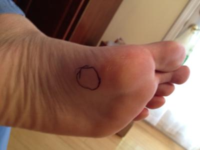 bump on bottom of foot