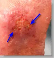 venous stasis ulcer