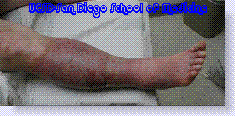 venous stasis