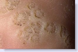 multiple plantar warts