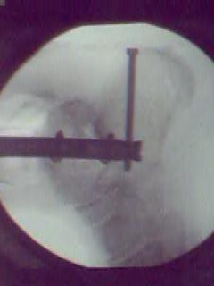 fixation of distal tibia 