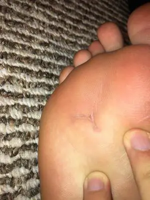 scar on bottom of foot from foreign body