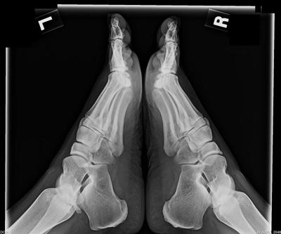 heel spur