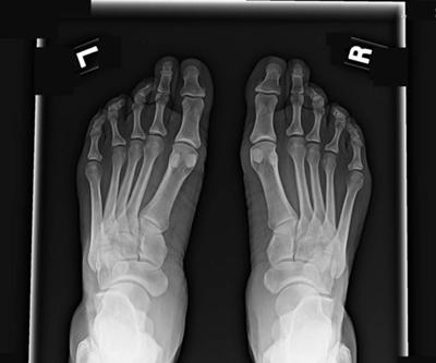 osteoporosis in the foot