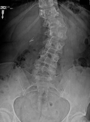 scoliosis