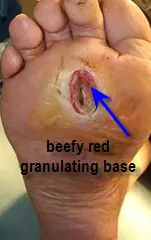 ulcer with granulating base