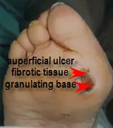 ulcer with granulating and fibrotic base