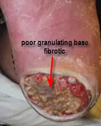 ulcer with fibrotic base