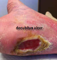 decubitus ulcer