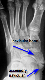 accessory_naviculare