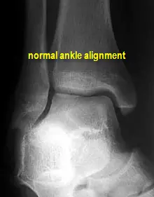 normal ankle mortise xray