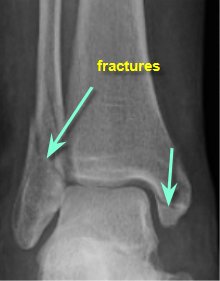ankle fracture xray