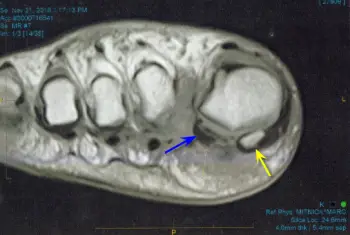 avascular necrosis of sesamoid bone