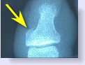 bone spur on big toe