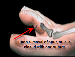 post op second toe for soft corn removal
