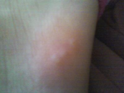 skin rash on foot
