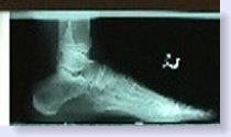 normal xray of foot vs. charcot foot xray