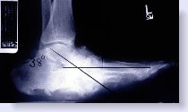 charcot xray of foot compared to normal xray
