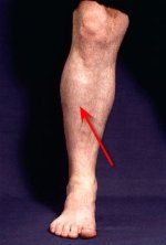 compartment_syndrome location