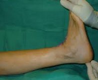 ankle equinus deformity