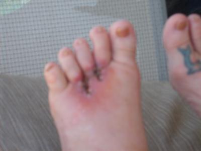 1 month post op for Mortons neuroma