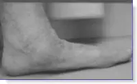 anatomical flatfoot