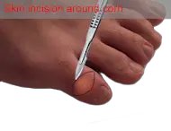 skin incision for derotational arthroplasy fifth toe