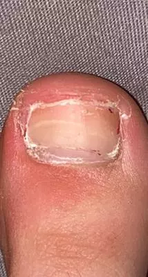 Left big toenail w/out the dot and outline (I removed the black dot) 