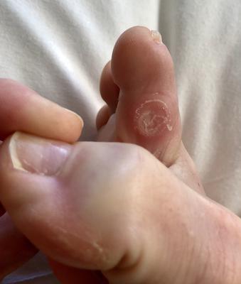 Inflamed area of 2nd toe at hammertoe healing site