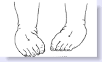 intoeing of feet